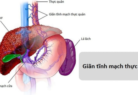 Nguyên nhân phổ biến nào gây ra xuất huyết tiêu hóa?